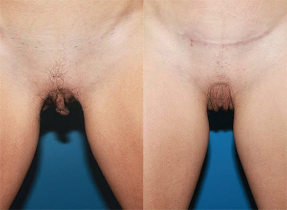 Labiaplasty Before & After Gallery - Patient 677283 - Image 1