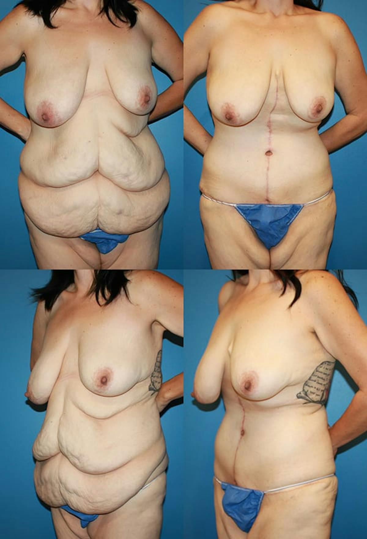 Tummy Tuck Before & After Gallery - Patient 108245 - Image 1