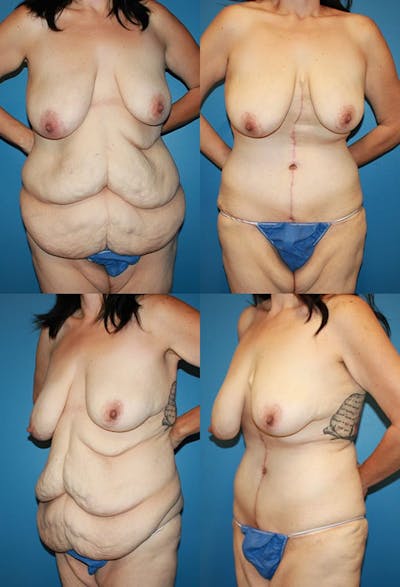 Tummy Tuck Before & After Gallery - Patient 108245 - Image 1