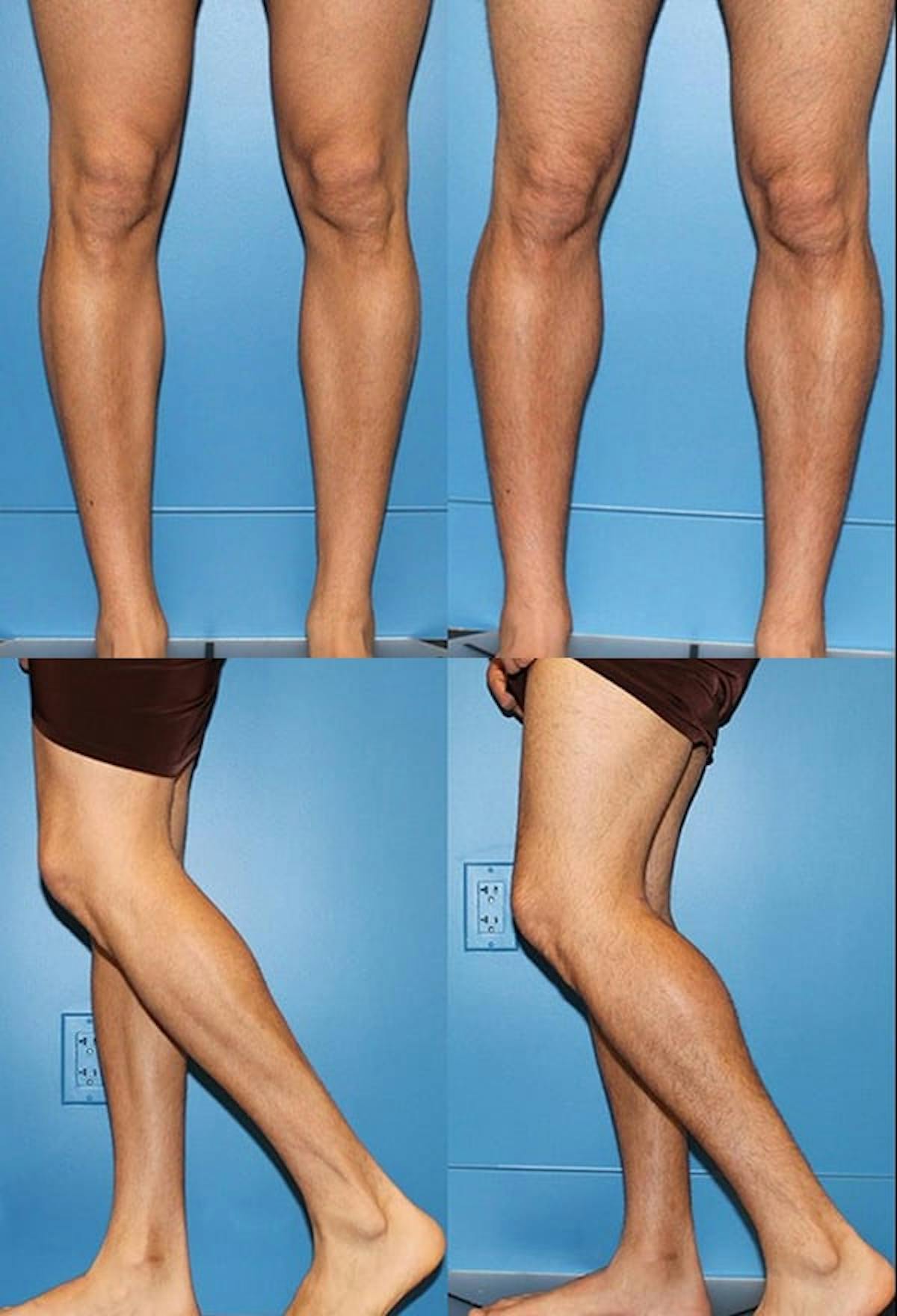 Calf Augmentation Before & After Gallery - Patient 113955 - Image 1