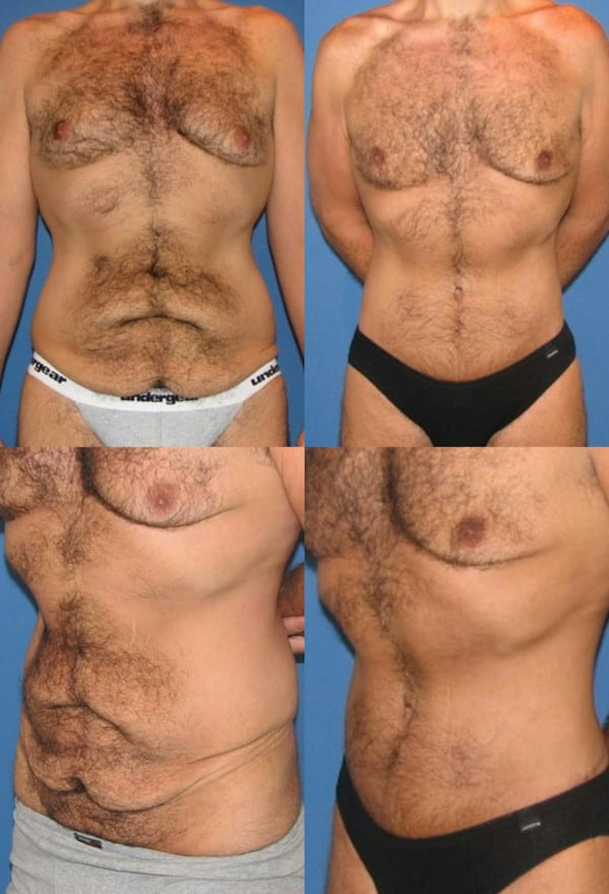 Tummy Tuck Before & After Gallery - Patient 122276 - Image 1