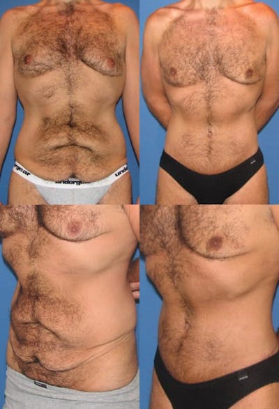 Tummy Tuck Before & After Gallery - Patient 122276 - Image 1
