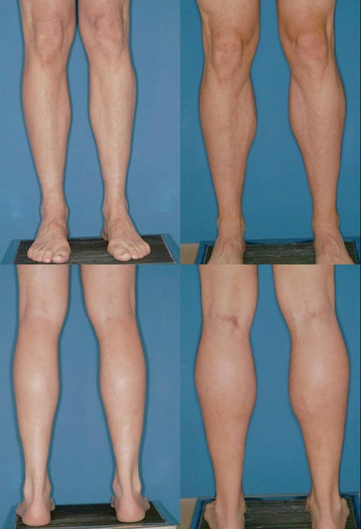 Calf Augmentation Before & After Gallery - Patient 427430 - Image 1