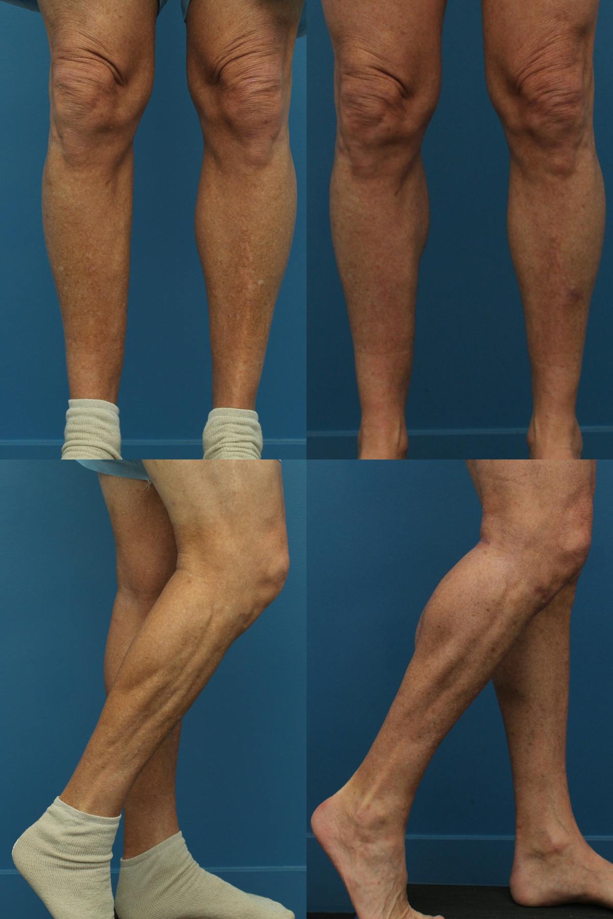 Calf Augmentation Before & After Gallery - Patient 267714 - Image 1