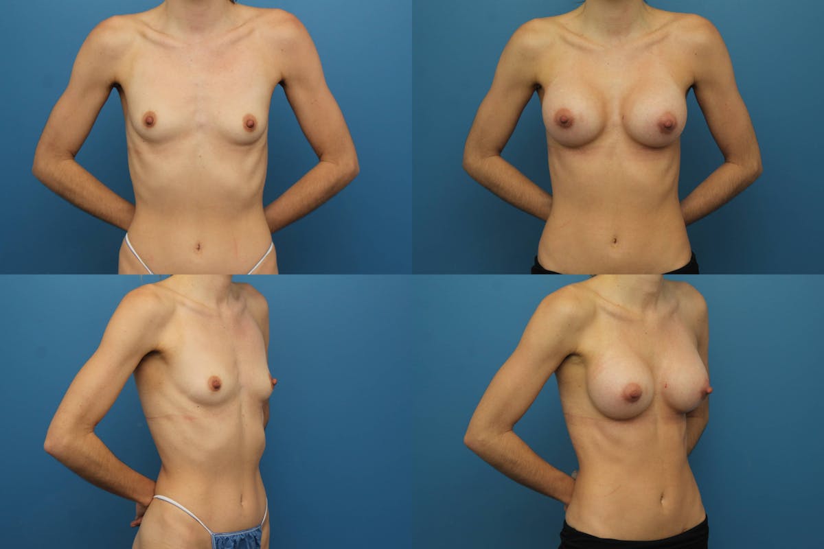 Breast Augmentation Before & After Gallery - Patient 148377 - Image 1