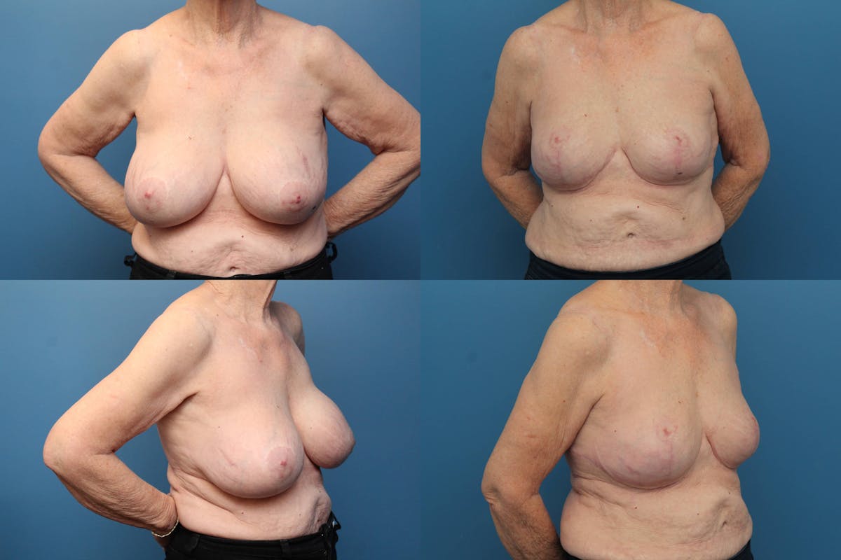 Breast Implant Removal Before & After Gallery - Patient 113841 - Image 1