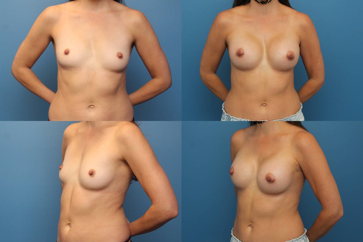 Breast Augmentation Before & After Gallery - Patient 266571 - Image 1