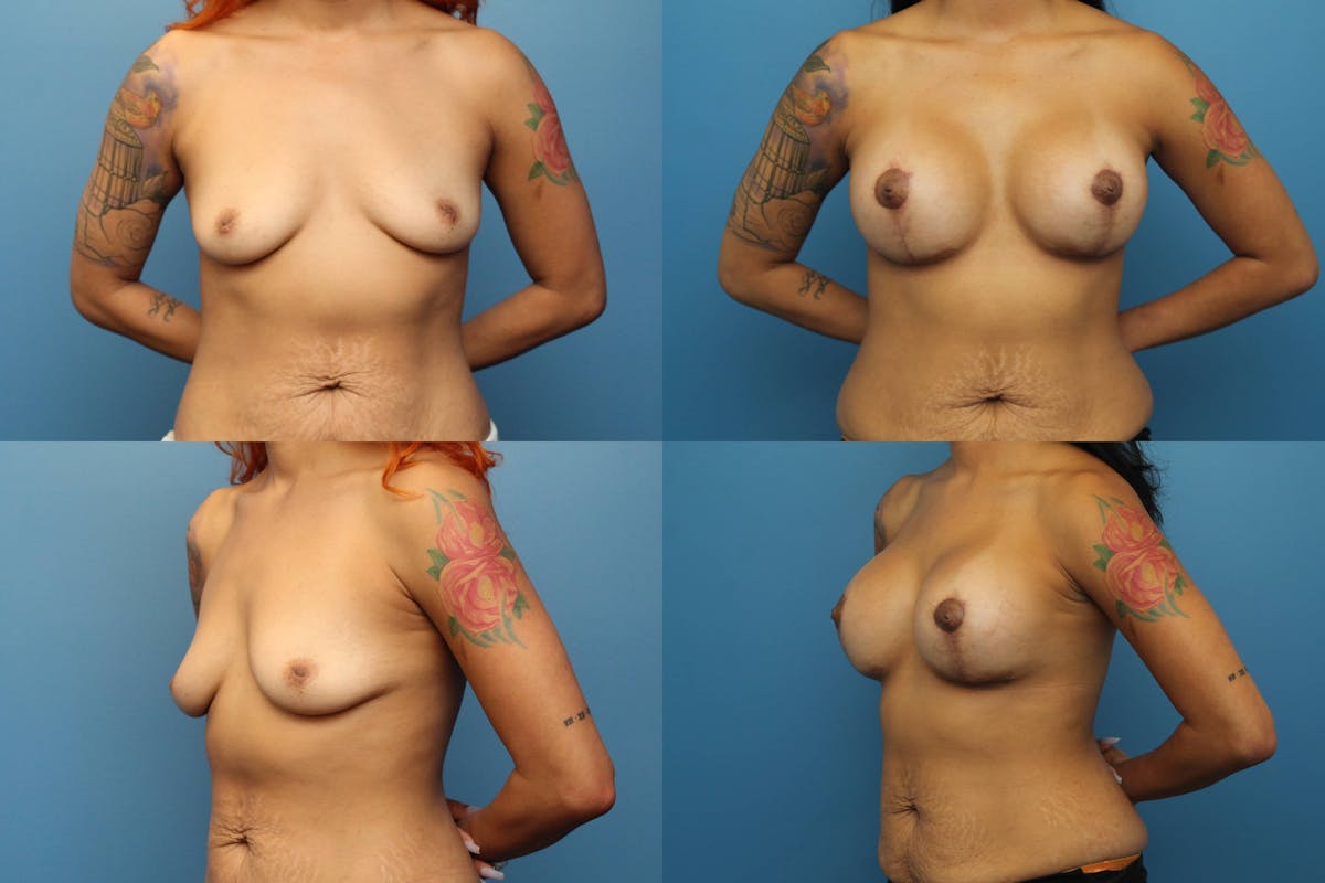 Breast Lift with Implants Before & After Gallery - Patient 335992 - Image 1