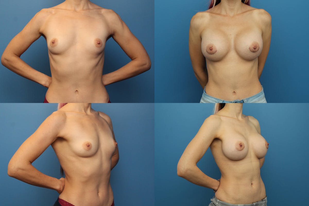 Breast Augmentation Before & After Gallery - Patient 275013 - Image 1