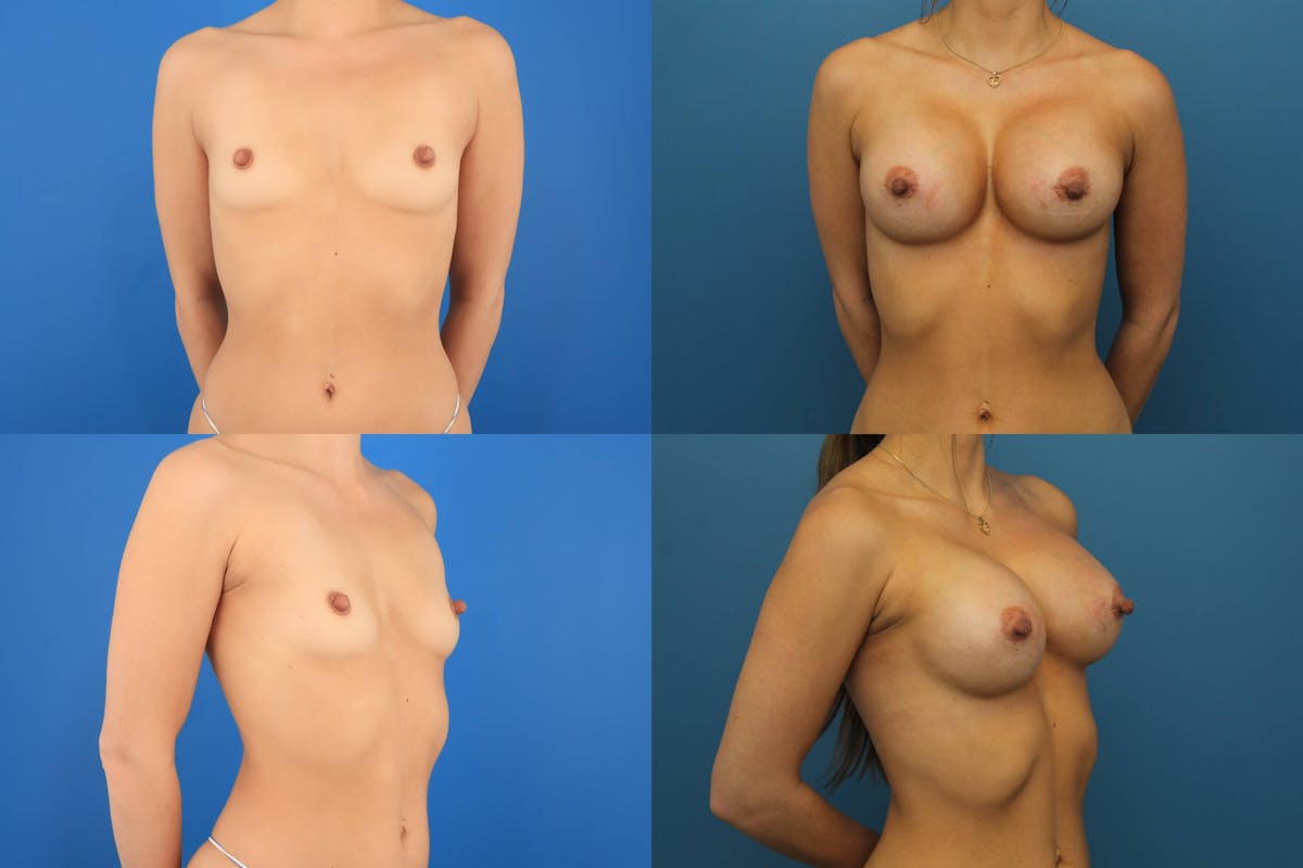 Breast Augmentation Before & After Gallery - Patient 326095 - Image 1