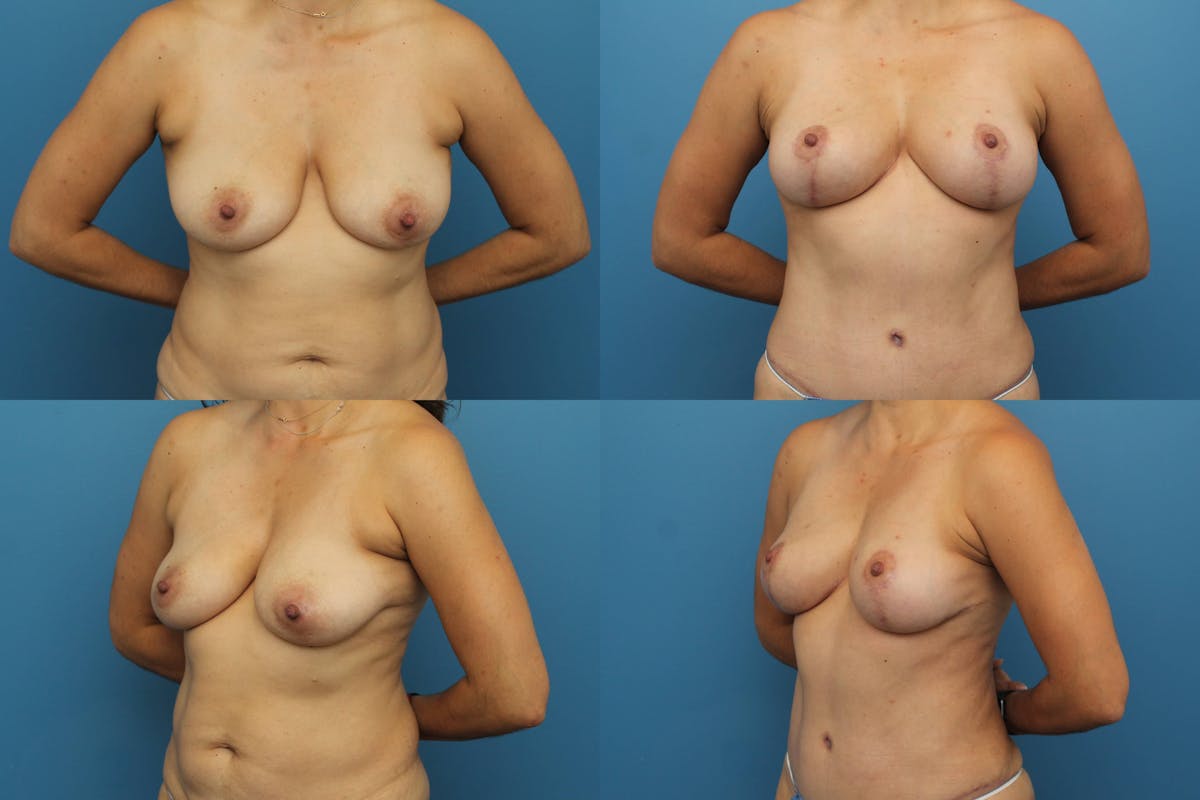 Breast Lift Before & After Gallery - Patient 152678 - Image 1