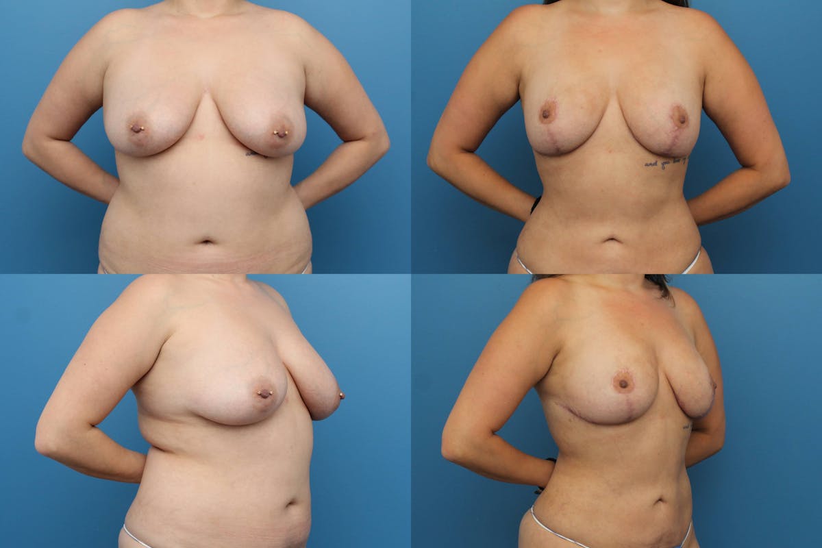 Breast Lift Before & After Gallery - Patient 193961 - Image 1