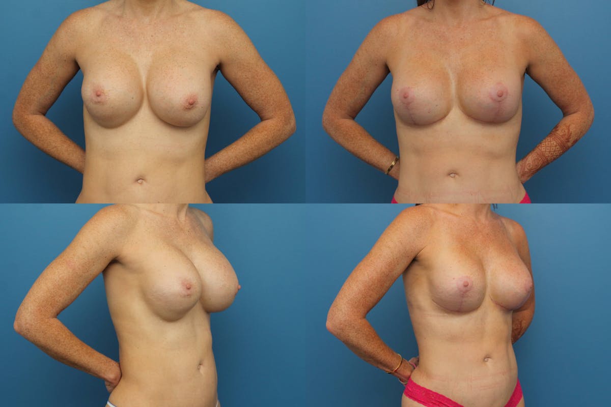 Breast Revision Before & After Gallery - Patient 257924 - Image 1