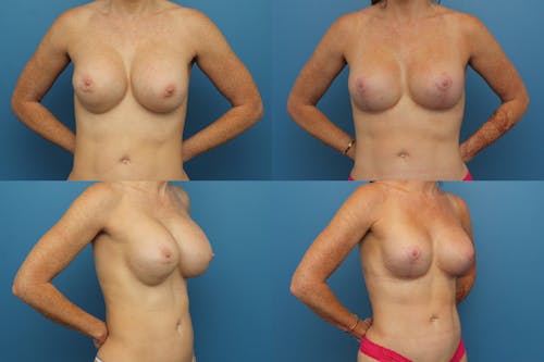 Patient 1 Before - Breast Revision