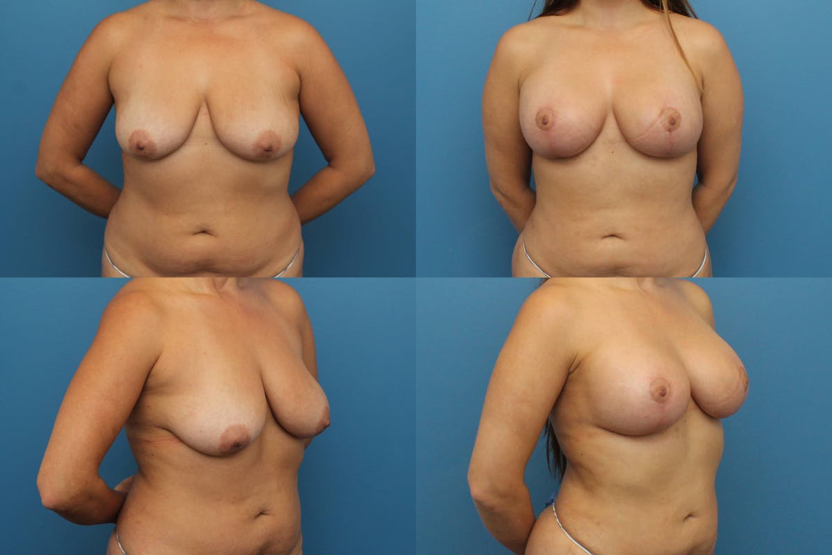 Breast Lift with Implants Before & After Gallery - Patient 315664 - Image 1