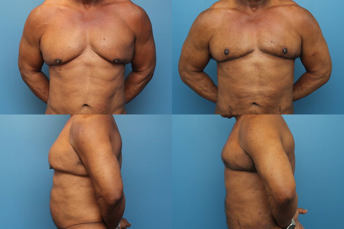 Male Breast Reduction / Gynecomastia Before & After Gallery - Patient 143617 - Image 1