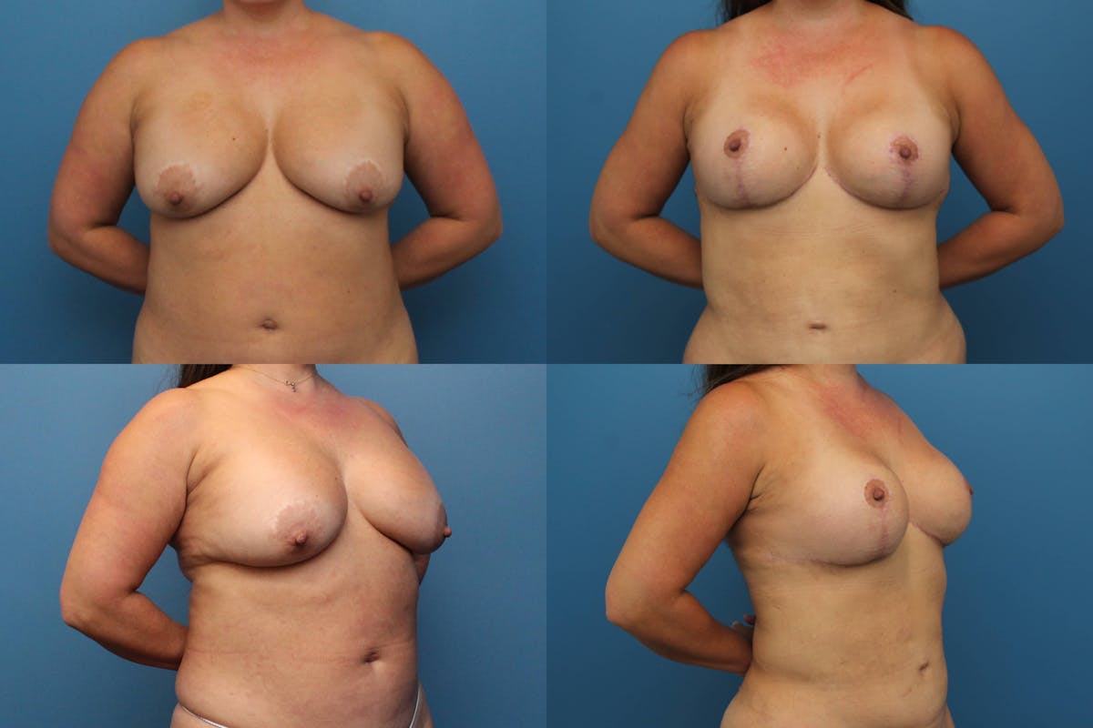 Breast Revision Before & After Gallery - Patient 312334 - Image 1