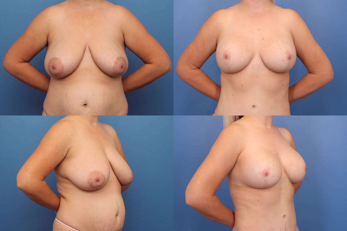 Reductive Augmentation of the Breast Before & After Gallery - Patient 990125 - Image 1