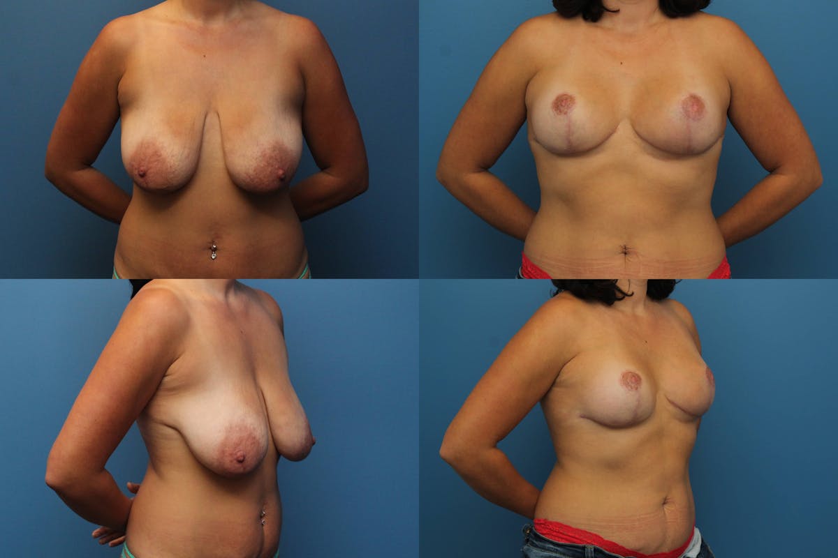 Reductive Augmentation of the Breast Before & After Gallery - Patient 382791 - Image 1