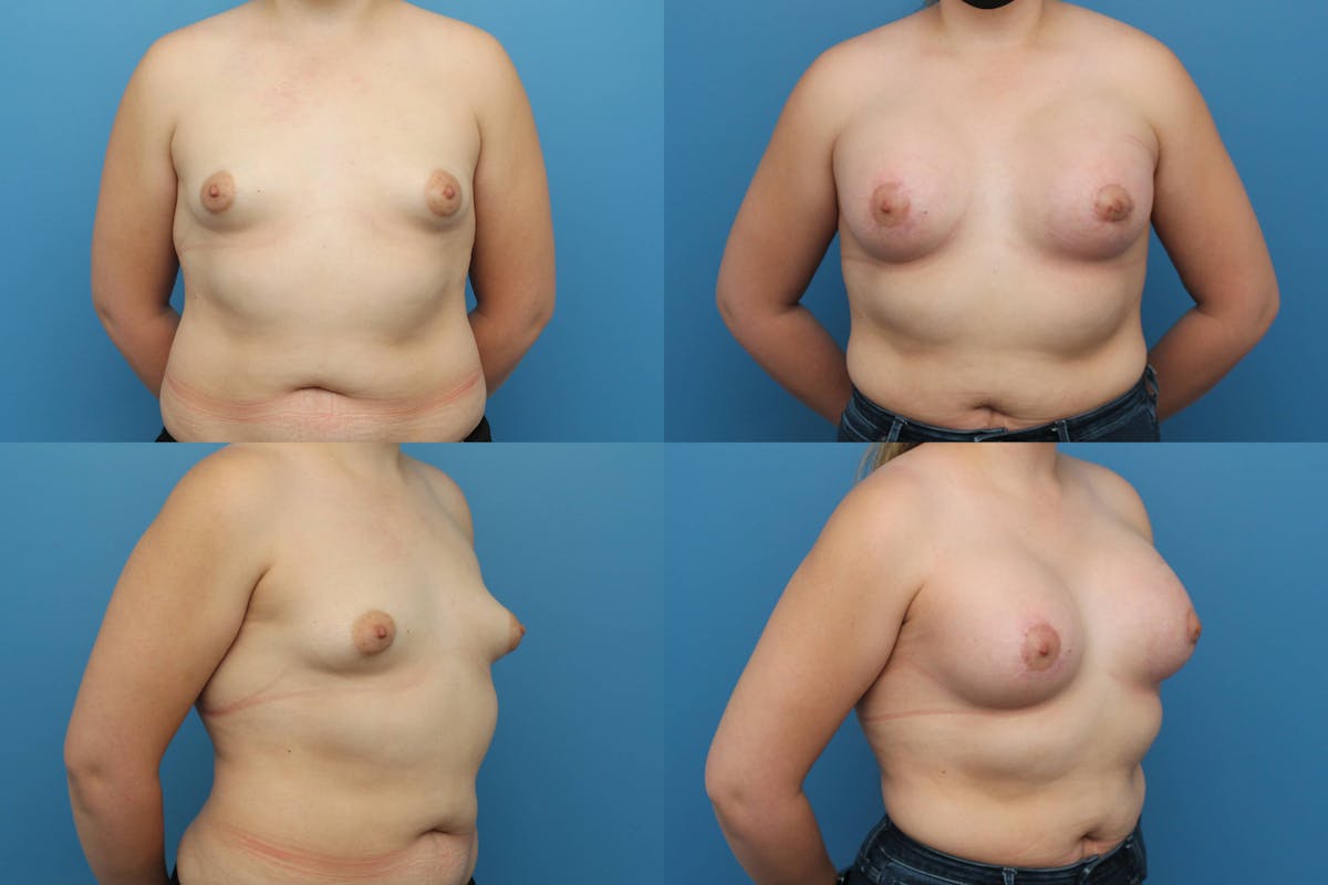 Tuberous Breast Correction Before & After Gallery - Patient 133327 - Image 1