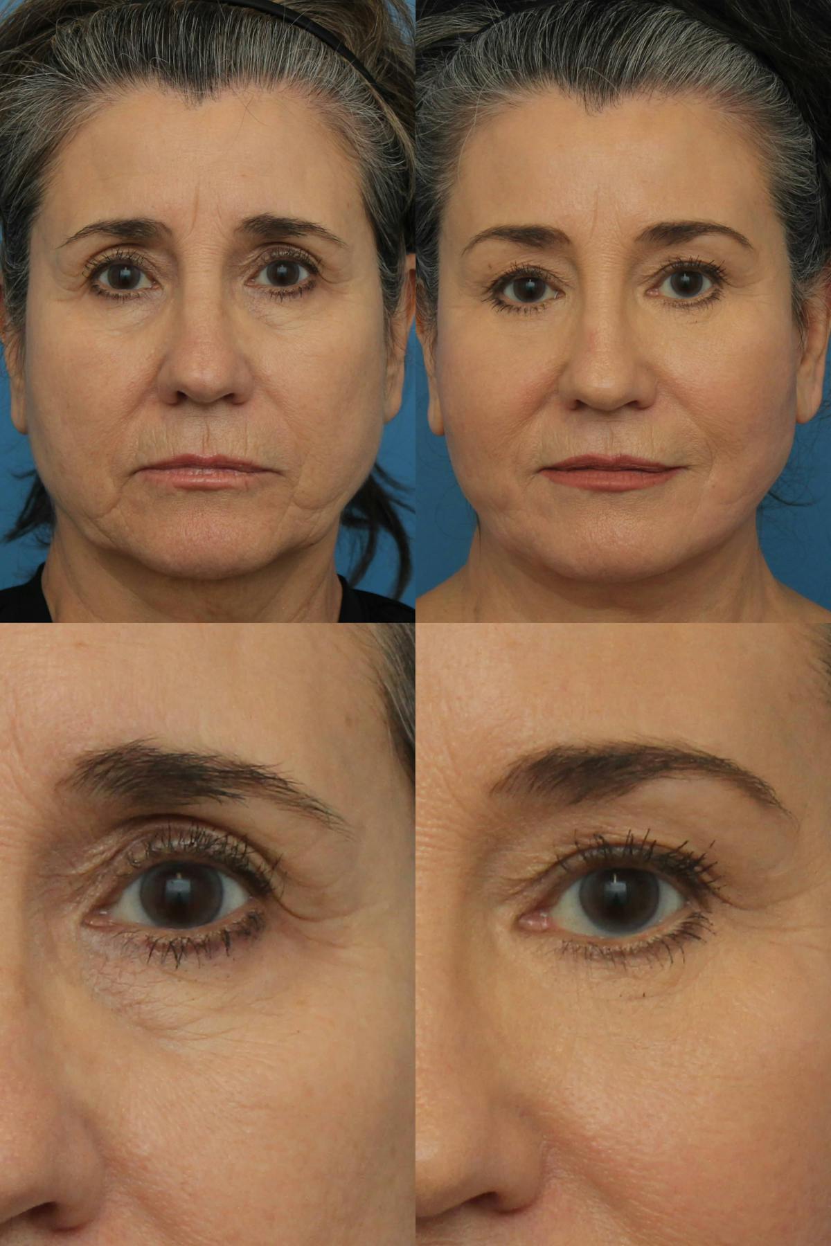Blepharoplasty Before & After Gallery - Patient 966663 - Image 1