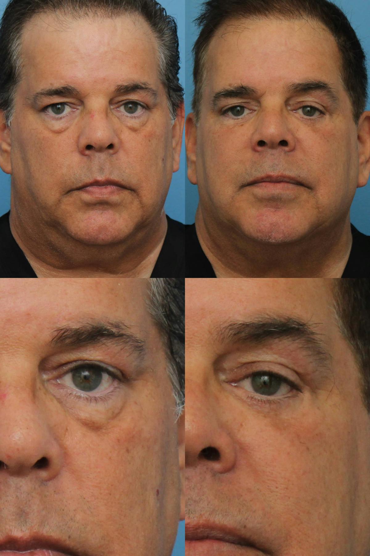 Blepharoplasty Before & After Gallery - Patient 147540 - Image 1