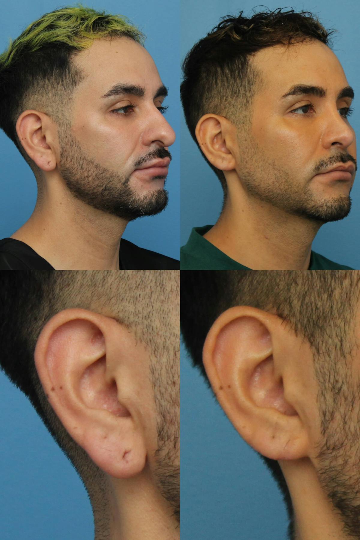 Earlobe Reduction Before & After Gallery - Patient 416509 - Image 1