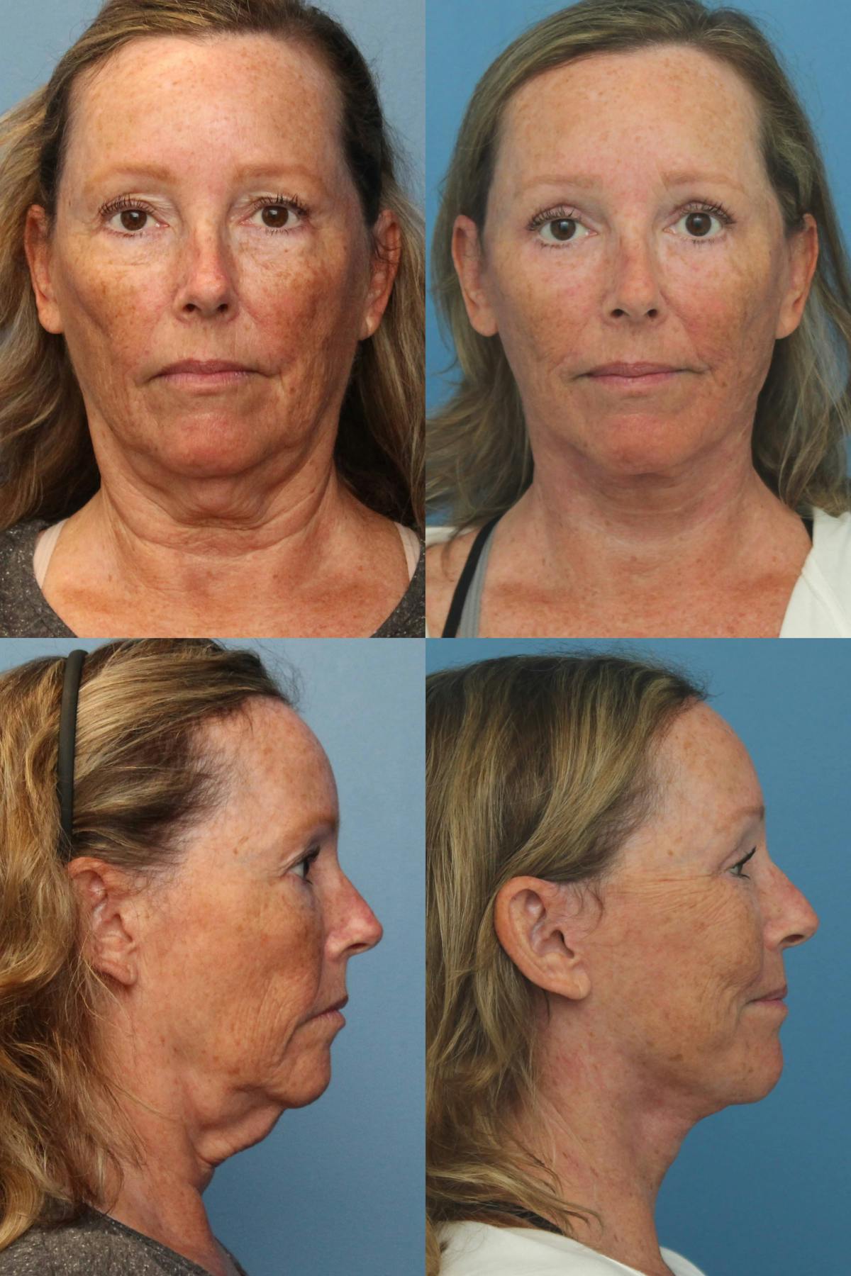 Facelift  Before & After Gallery - Patient 412231 - Image 1