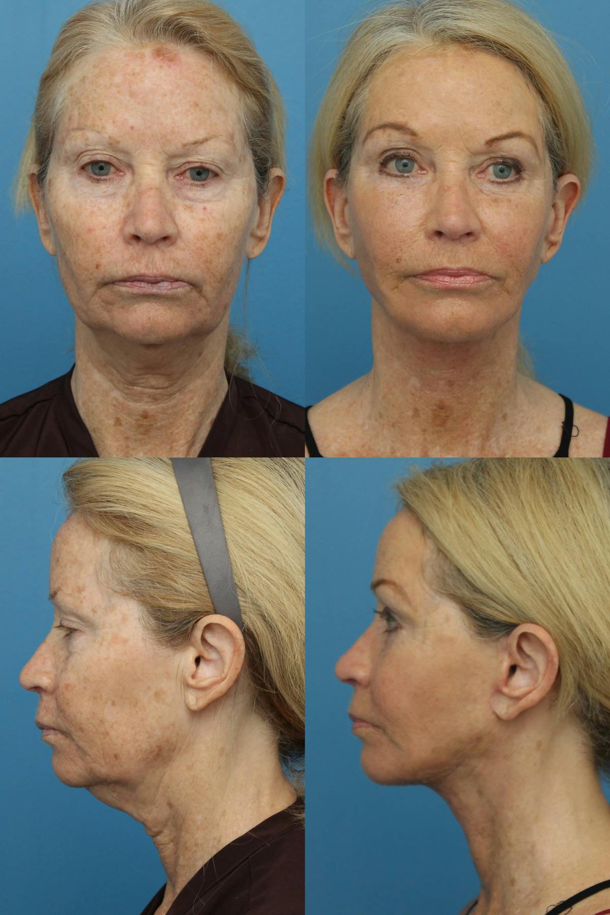 Facelift  Before & After Gallery - Patient 212117 - Image 1