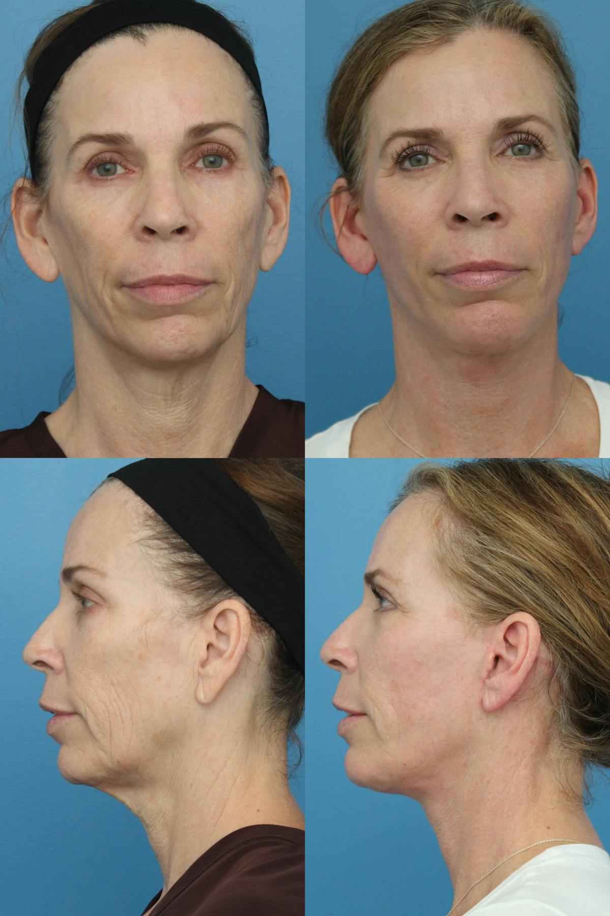 Facelift  Before & After Gallery - Patient 201362 - Image 1