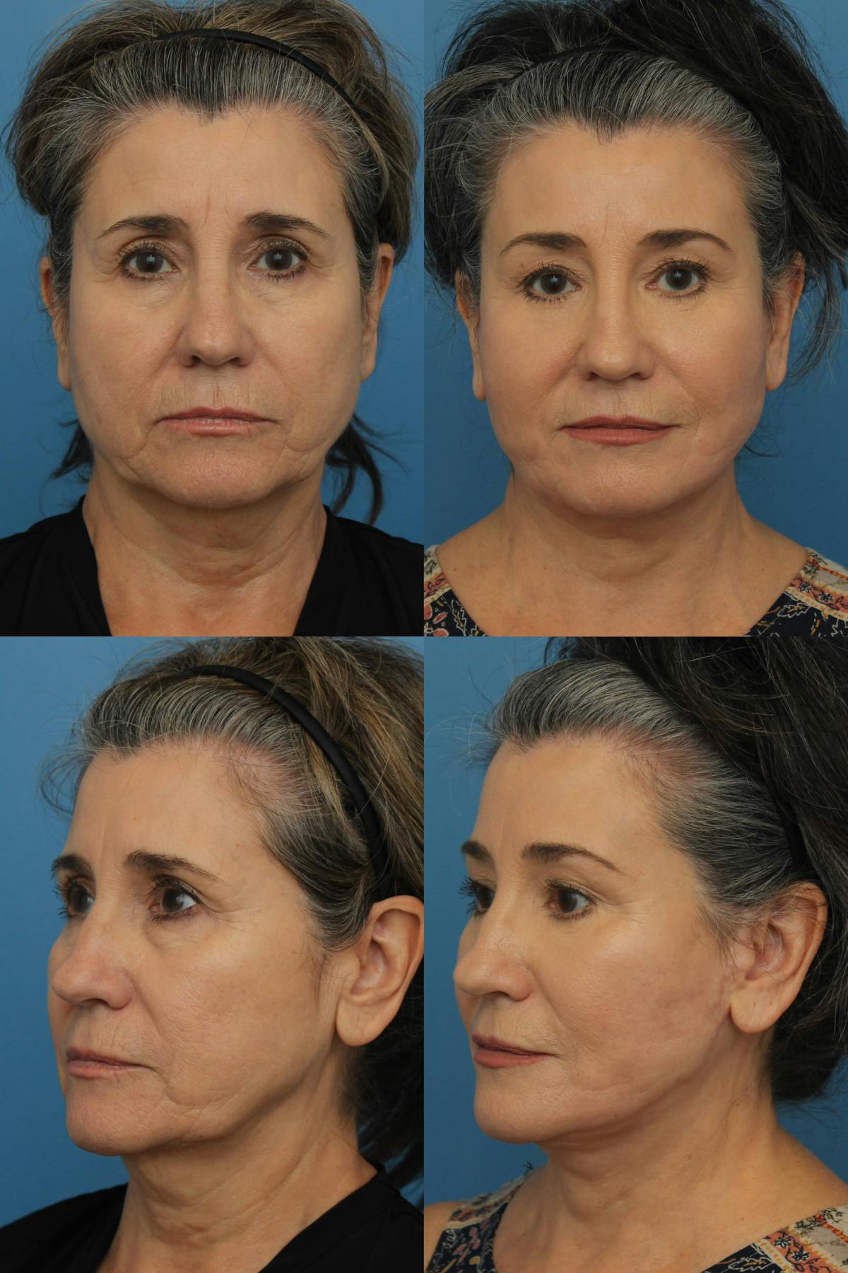 Facelift  Before & After Gallery - Patient 317360 - Image 1