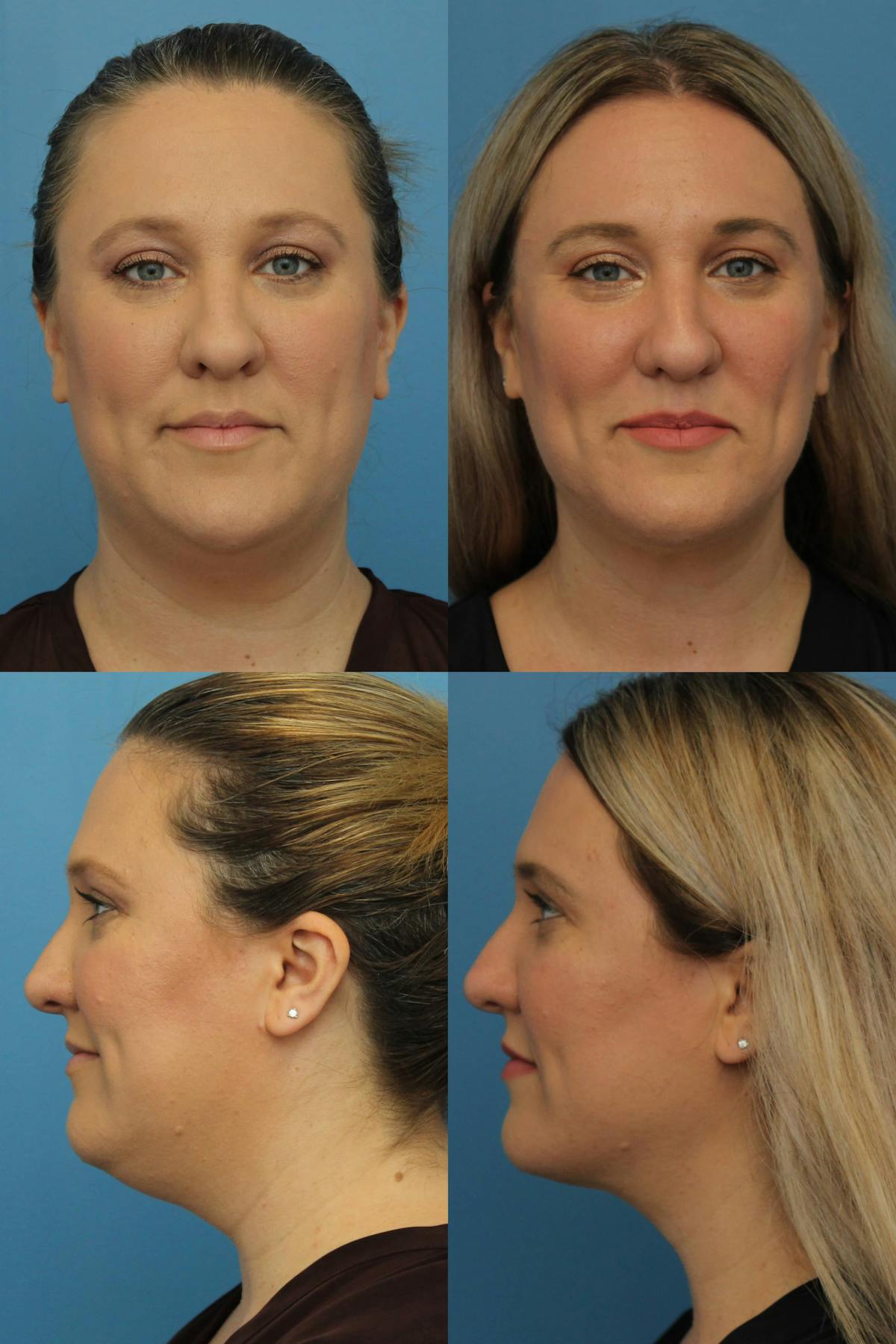 Neck Liposuction Before & After Gallery - Patient 691692 - Image 1