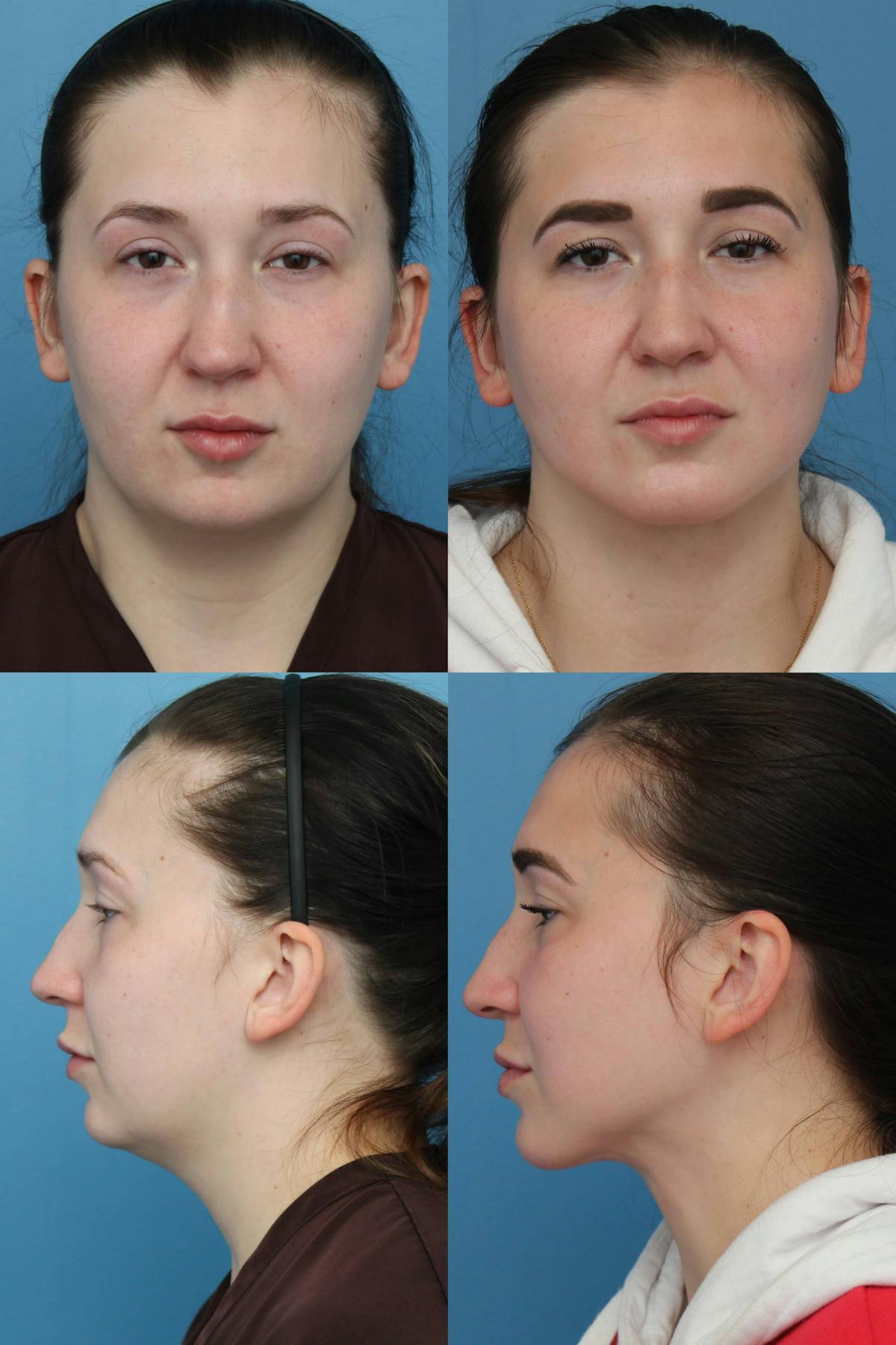 Neck Liposuction Before & After Gallery - Patient 132863 - Image 1