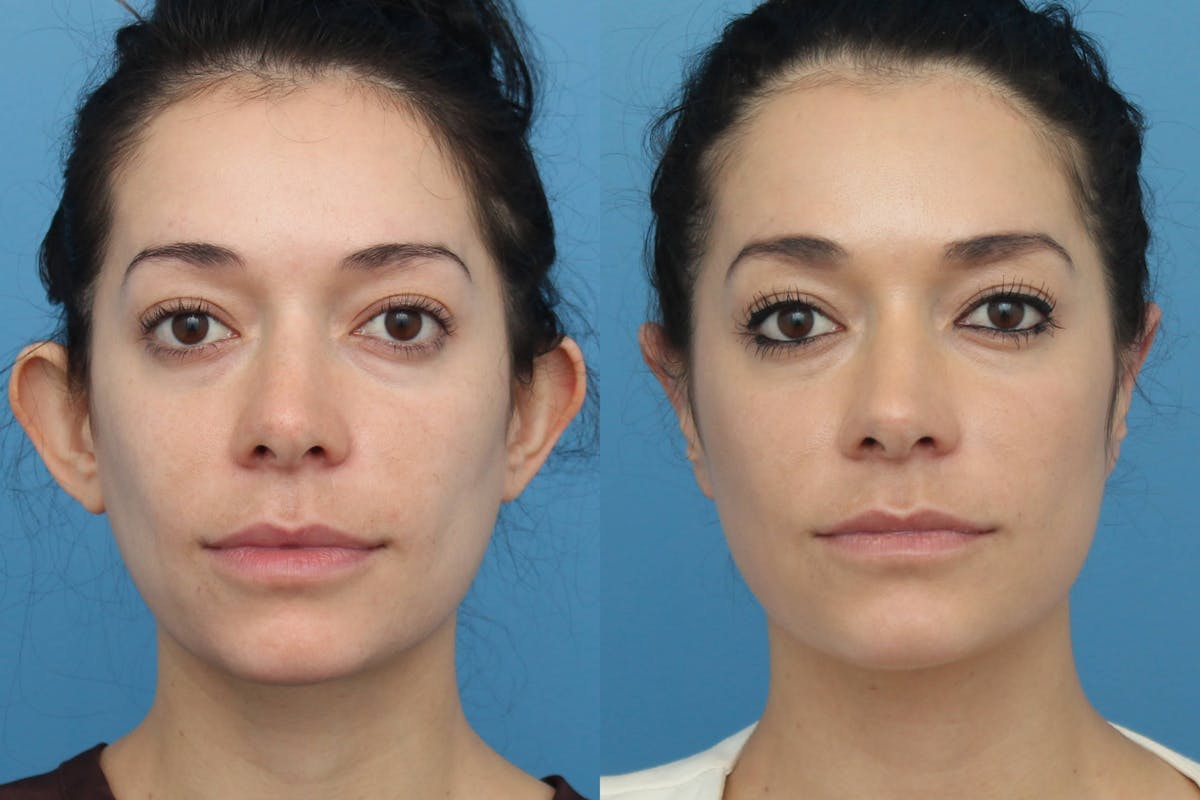 Otoplasty (Ear Surgery) Before & After Gallery - Patient 880096 - Image 1