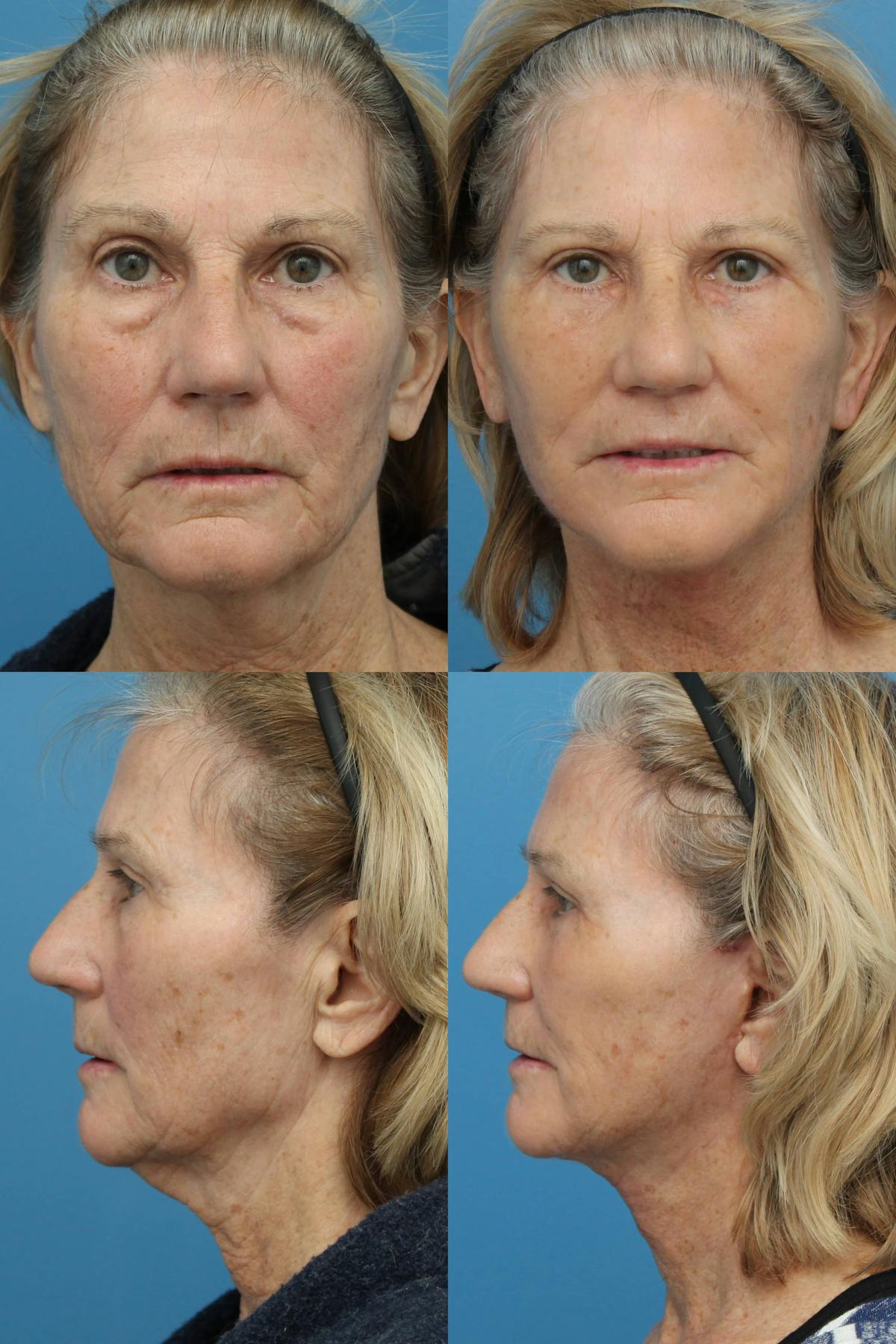 Facelift  Before & After Gallery - Patient 142494 - Image 1