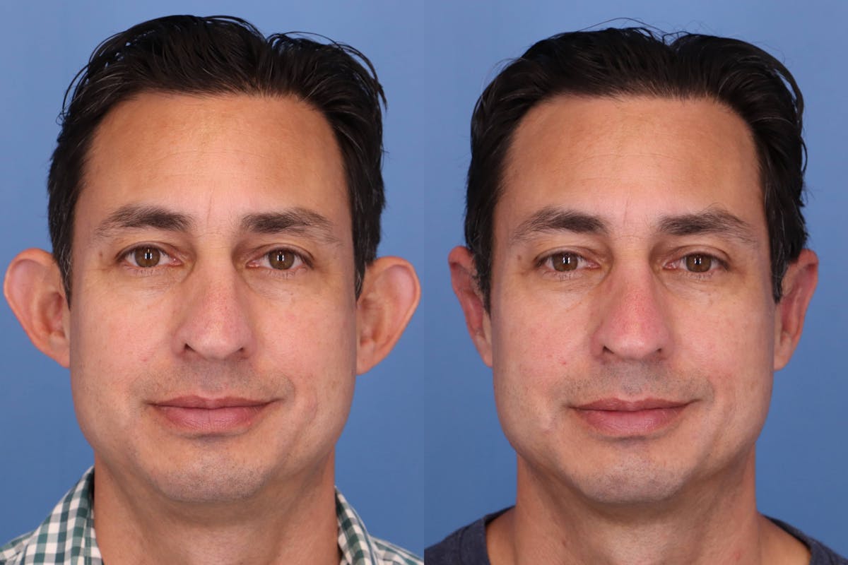 Otoplasty (Ear Surgery) Before & After Gallery - Patient 193983 - Image 1