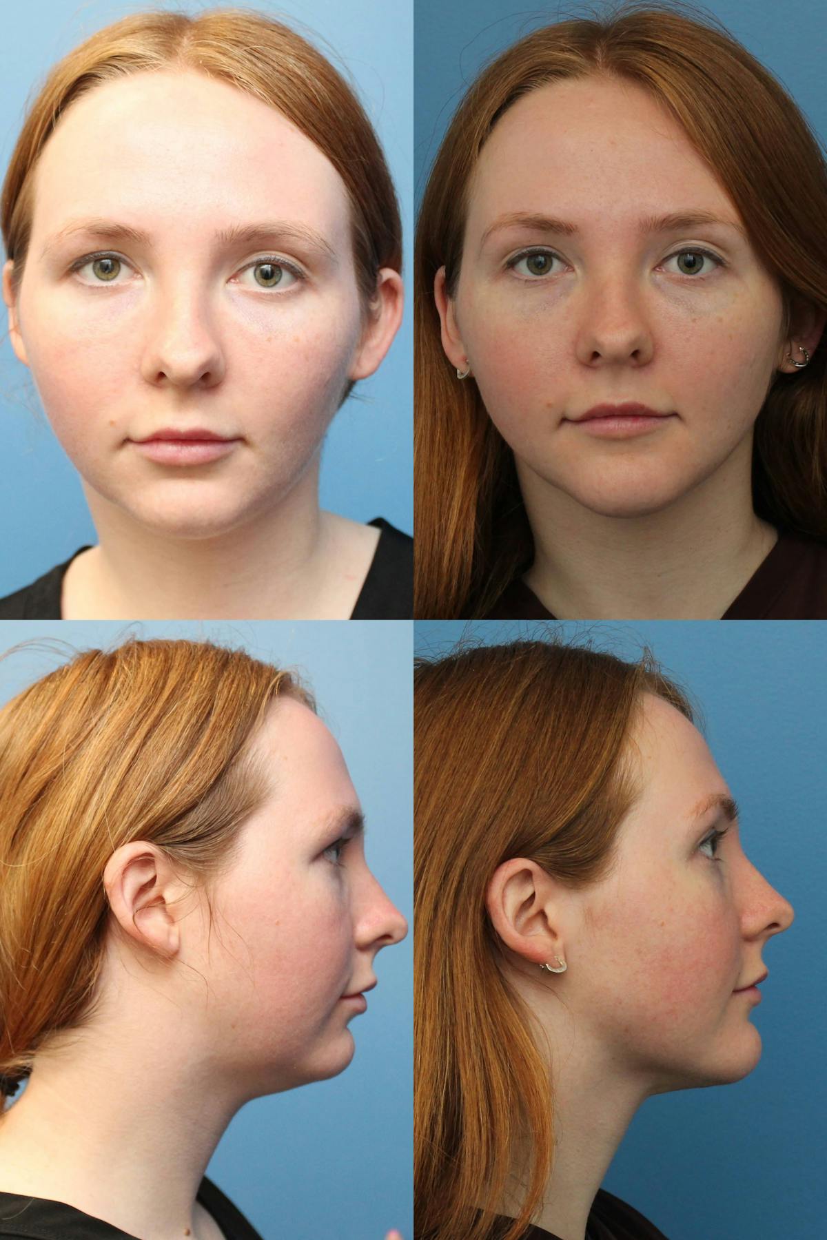 Neck Liposuction Before & After Gallery - Patient 144898 - Image 1