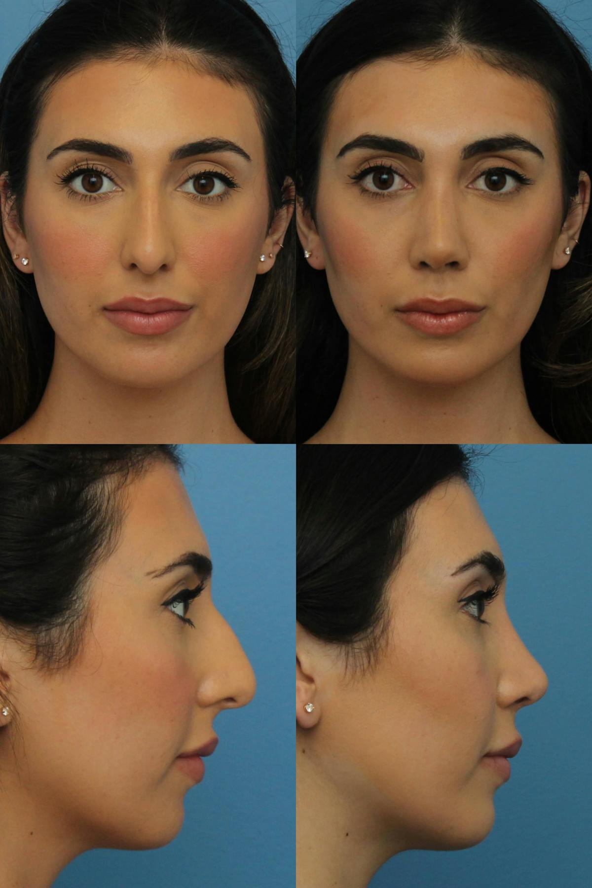Rhinoplasty Before & After Gallery - Patient 245077 - Image 1