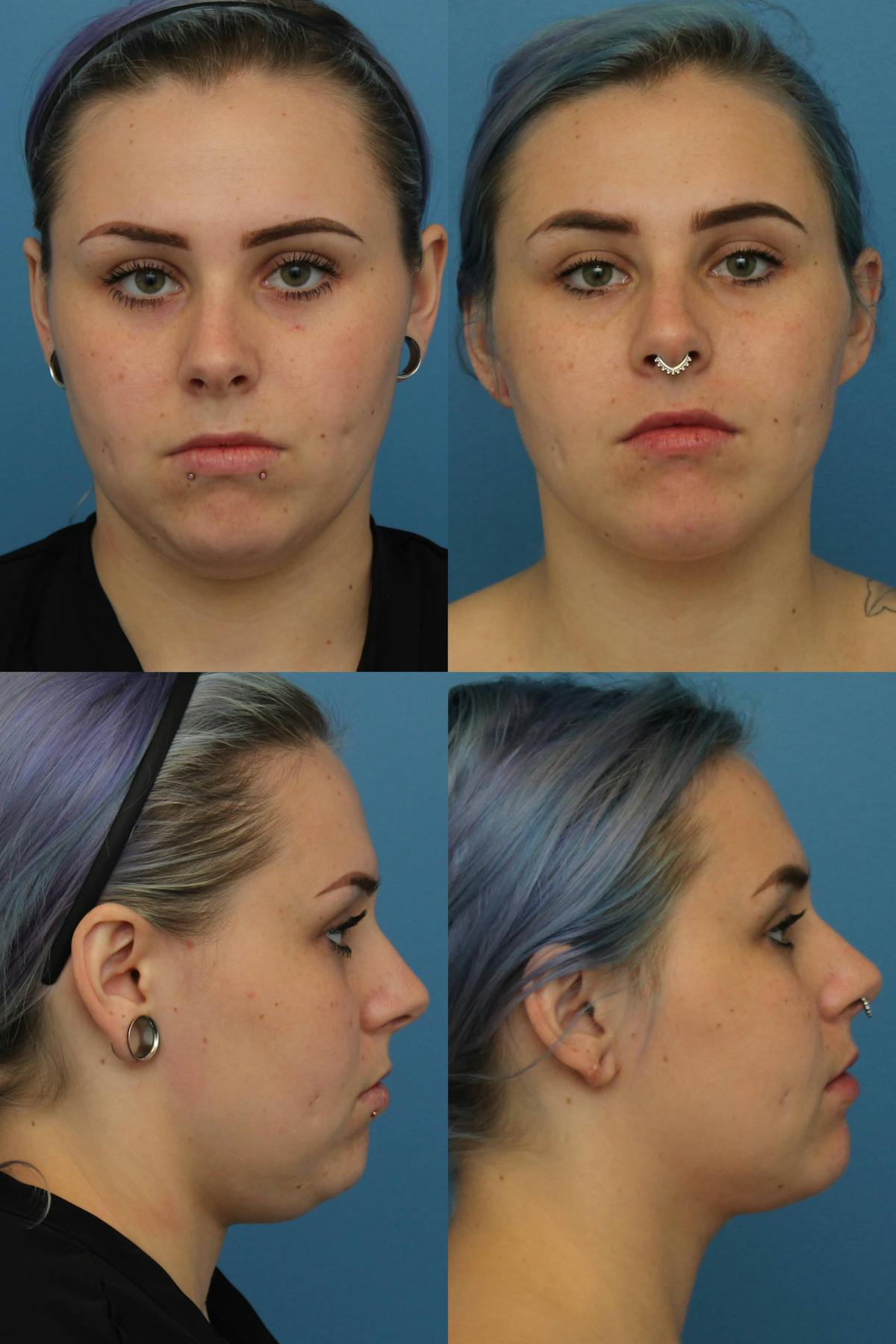 Neck Liposuction Before & After Gallery - Patient 322953 - Image 1