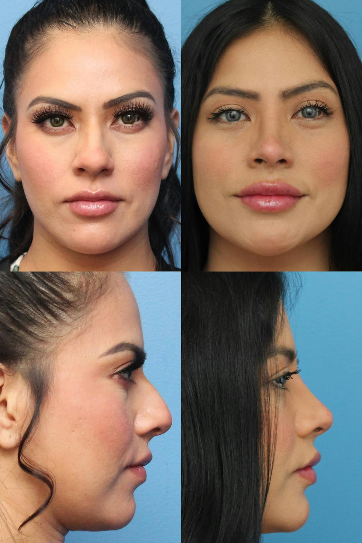 Rhinoplasty Before & After Gallery - Patient 157569 - Image 1