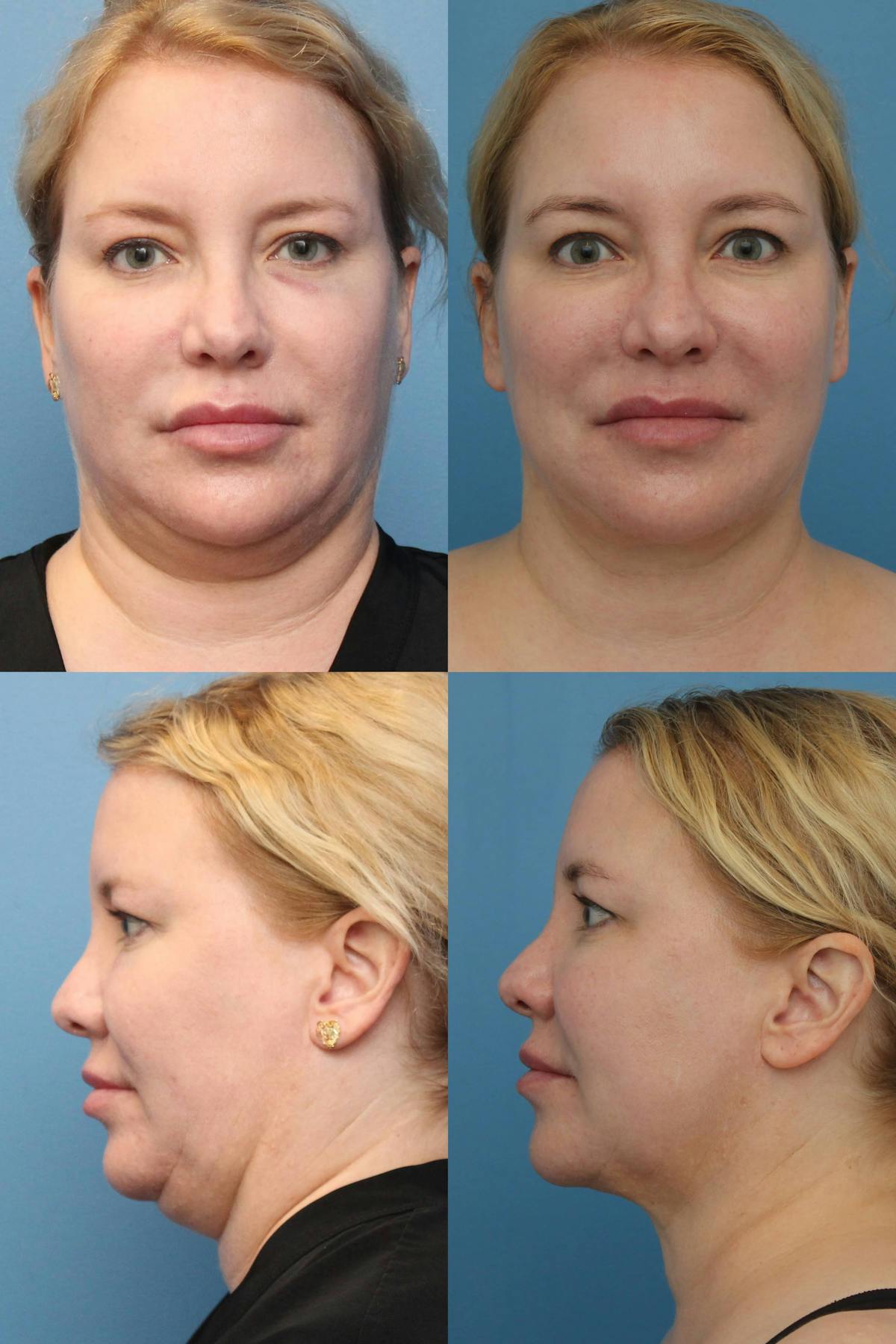 Neck Liposuction Before & After Gallery - Patient 323200 - Image 1