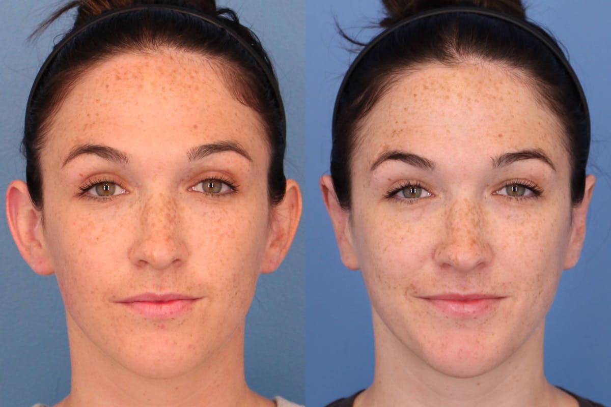 Otoplasty (Ear Surgery) Before & After Gallery - Patient 334230 - Image 1