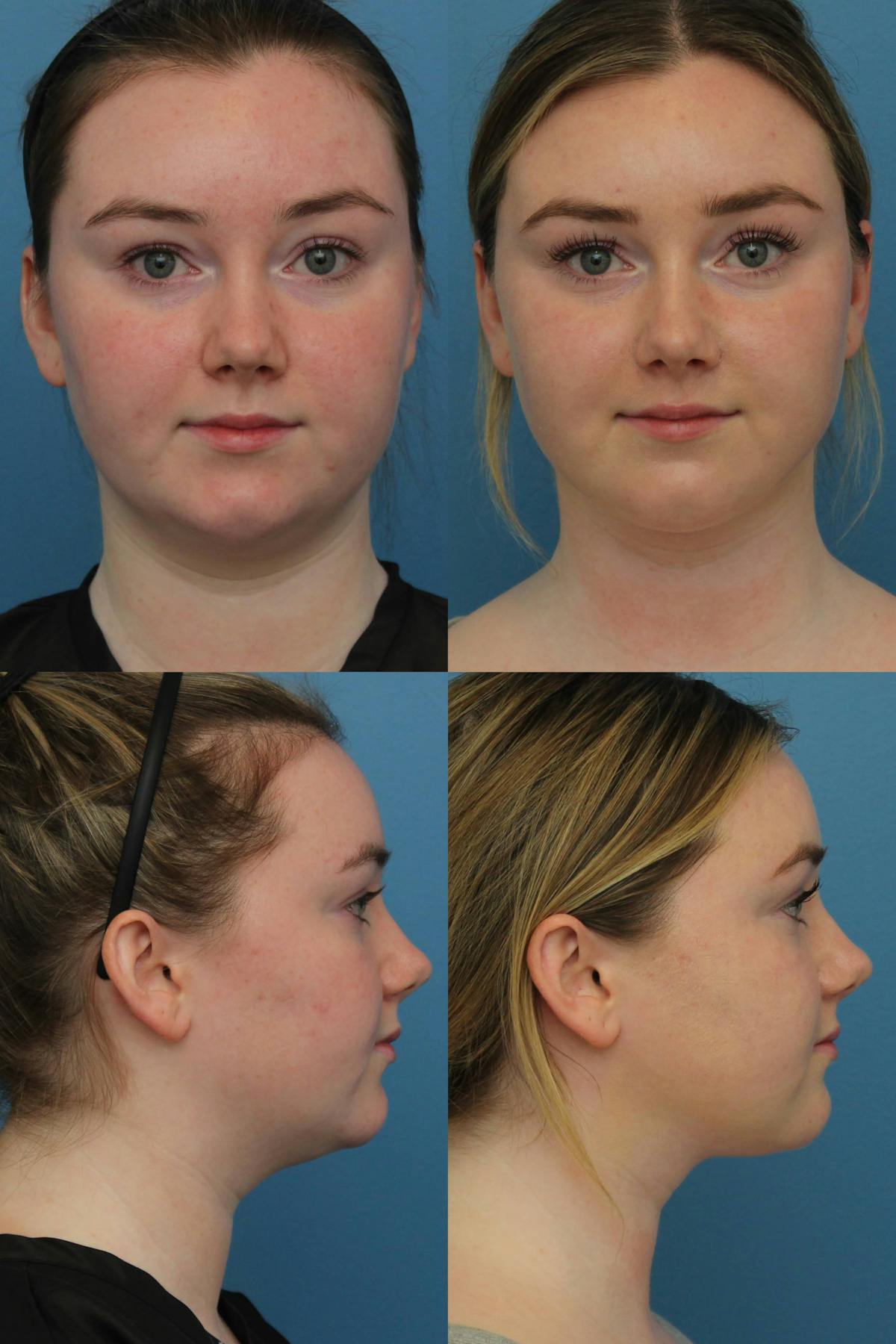 Neck Liposuction Before & After Gallery - Patient 144811 - Image 1