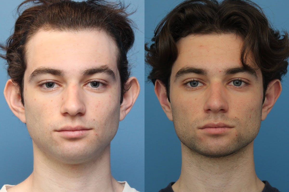 Otoplasty (Ear Surgery) Before & After Gallery - Patient 381869 - Image 1