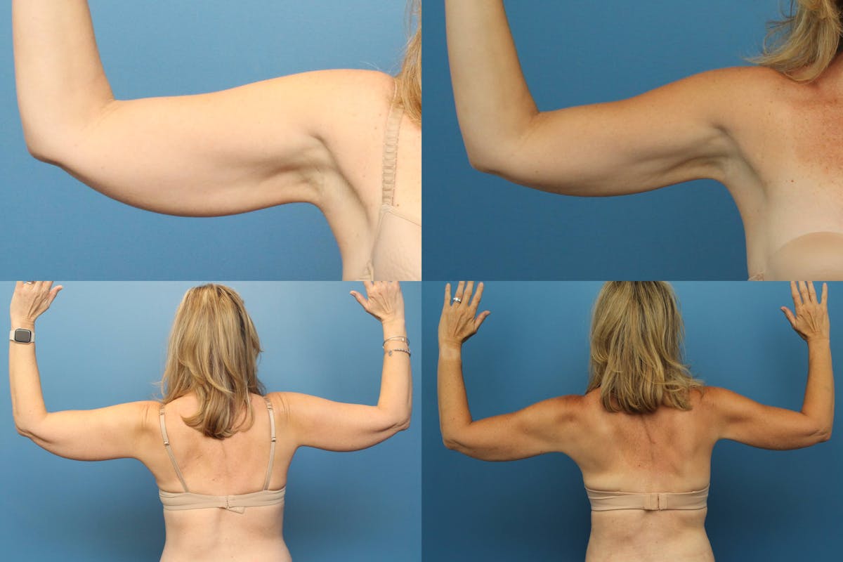 Arm Liposuction Before & After Gallery - Patient 382786 - Image 1