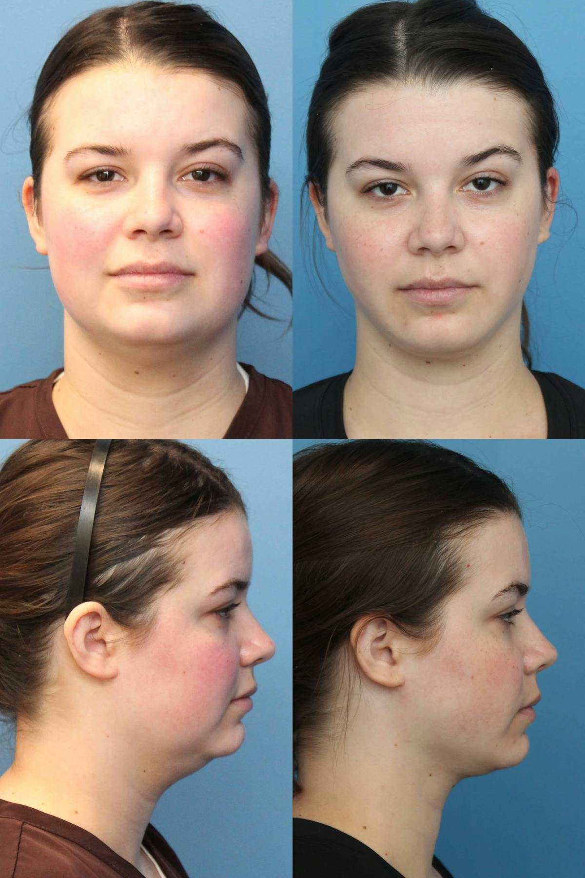 Neck Liposuction Before & After Gallery - Patient 209712 - Image 1