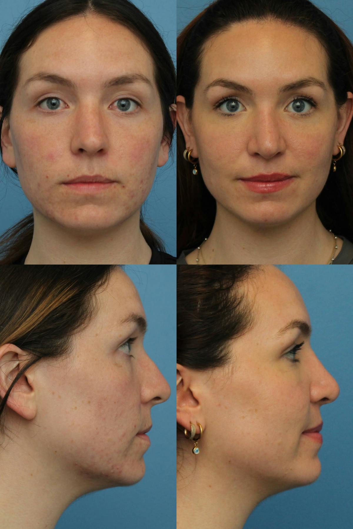 Rhinoplasty Before & After Gallery - Patient 535418 - Image 1