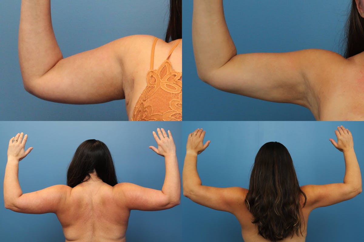 Arm Liposuction Before & After Gallery - Patient 259034 - Image 1