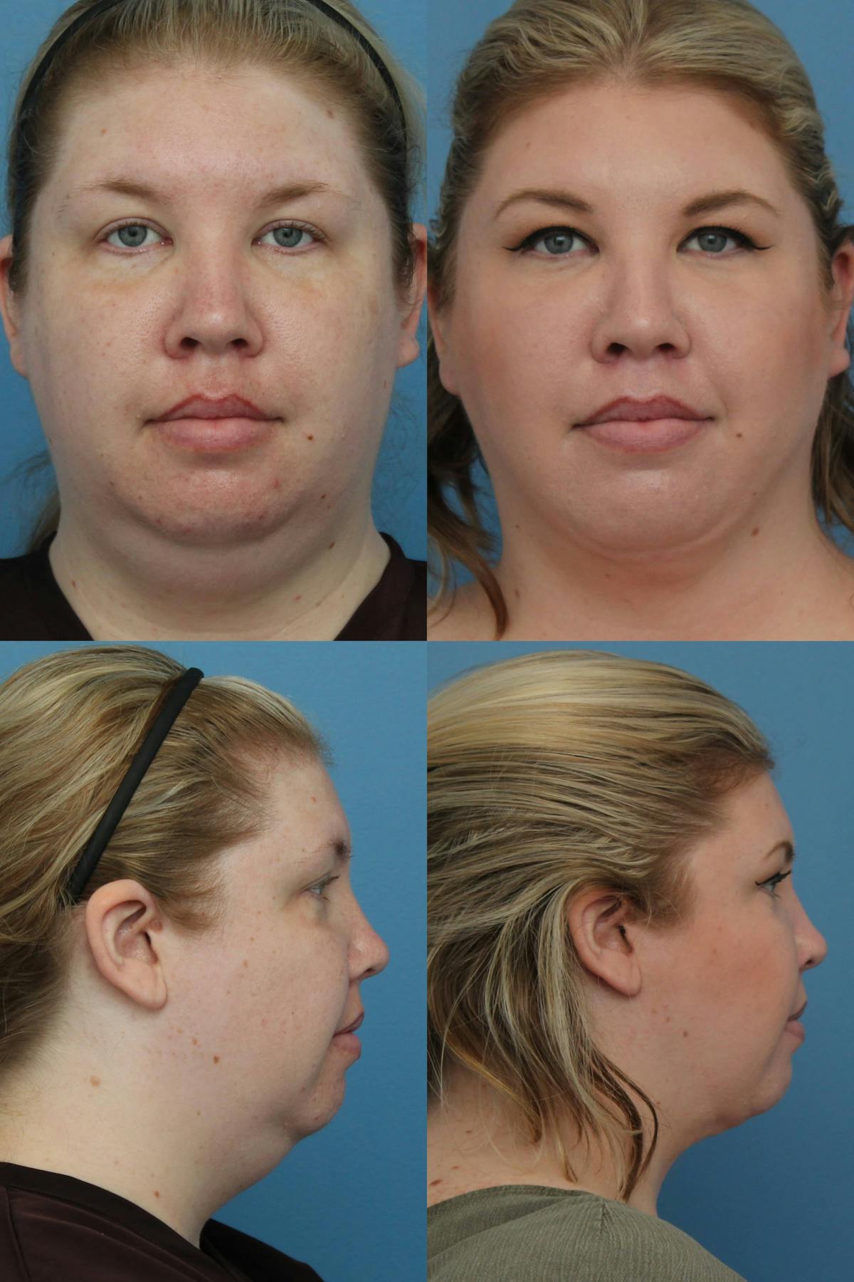 Neck Liposuction Before & After Gallery - Patient 253575 - Image 1