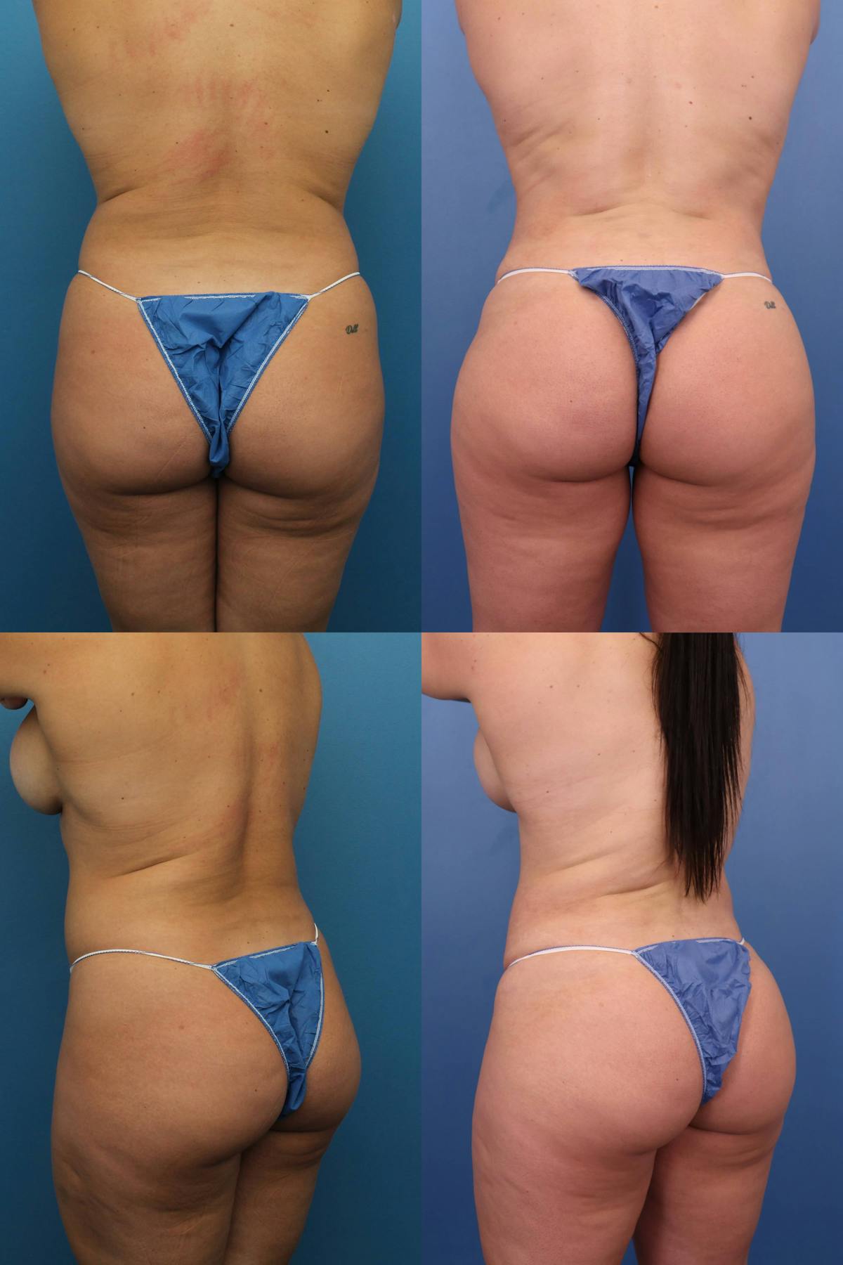 Brazilian Butt Lift Before & After Gallery - Patient 343248 - Image 1
